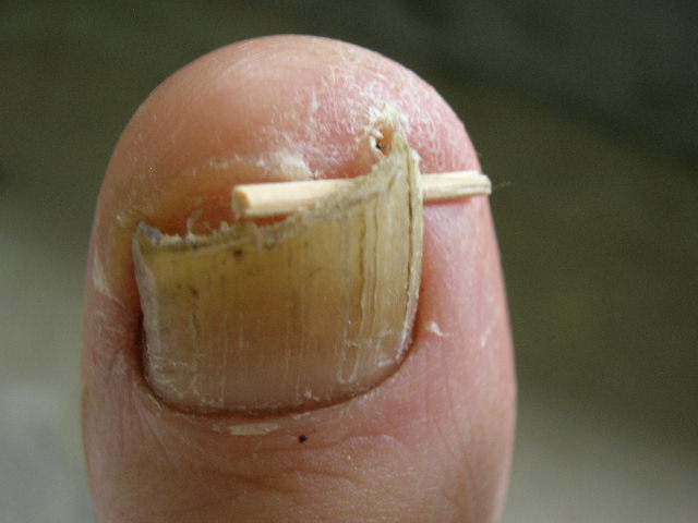 toenails Ingrown_toenail_toothpick shoes ingrown for