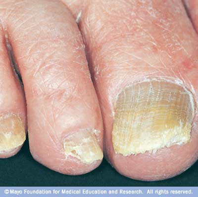 Fungal Infections - KidsHealth